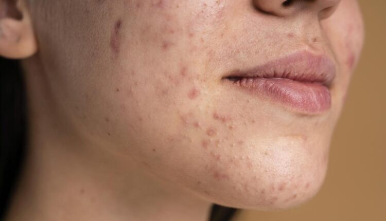 Pele do rosto com acne